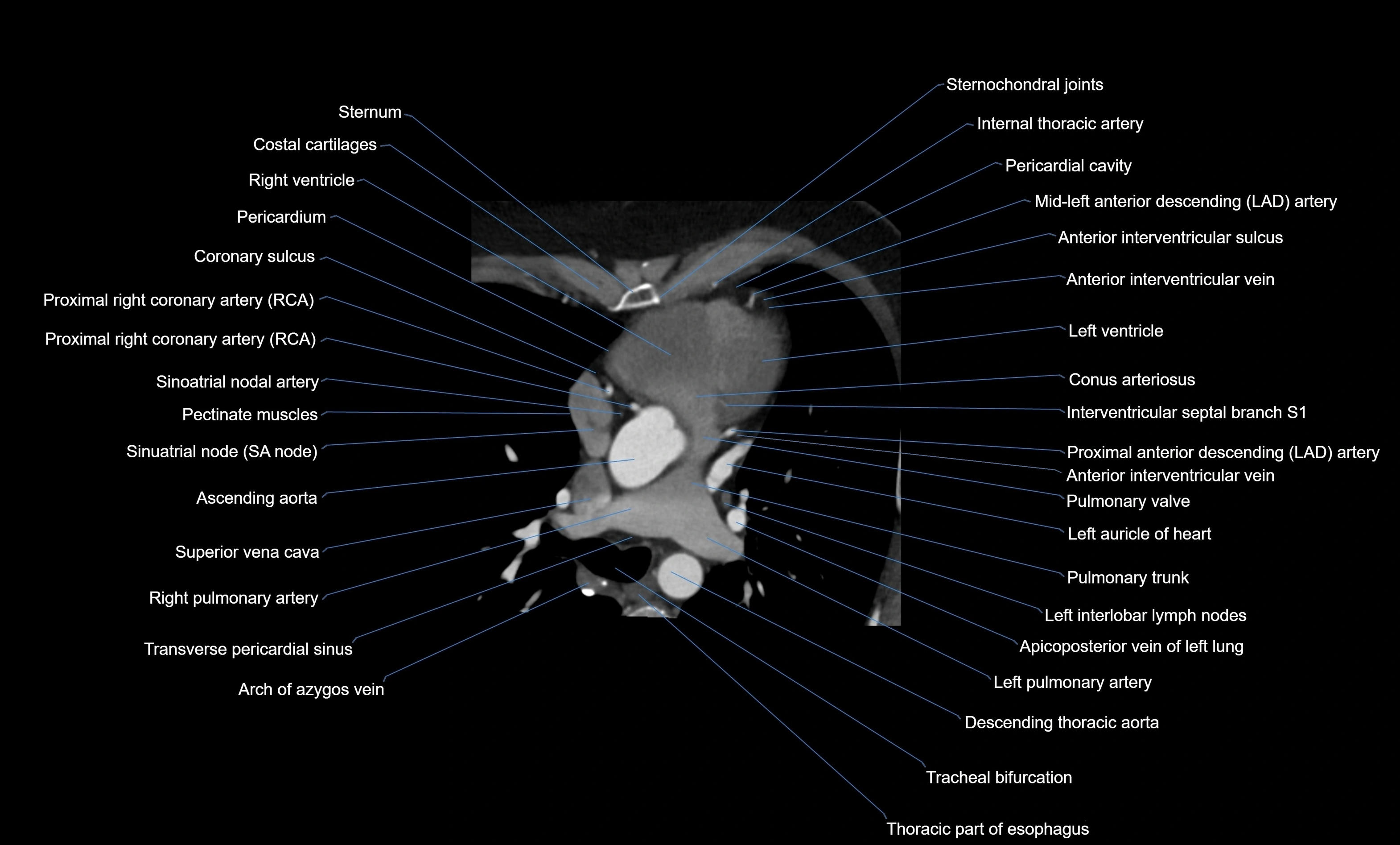 CT heart (coronary angiogram) four chamber view  cross sectional anatomy labelled radiology image -00018.webp